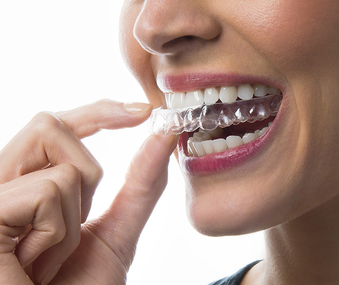 Aligner
