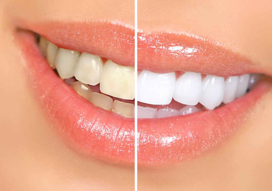 Brighten Your Smile: The Ultimate Guide to Teeth Whitening