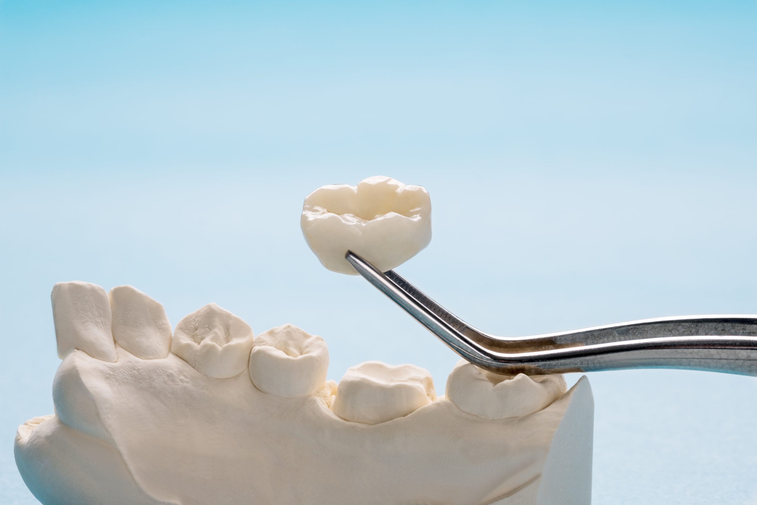 Perfecting your smile: Crown & Bridges​