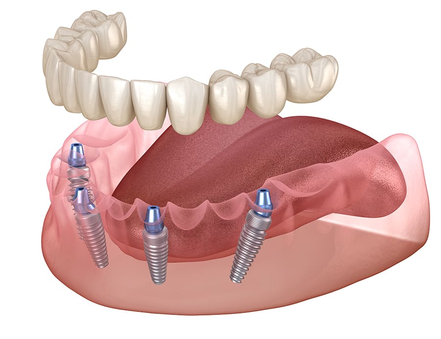 A Complete Smile Transformation: Full Mouth Rehab Explained
