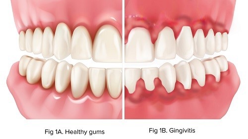Concerned about Bleeding Gums: Reasons and solutions