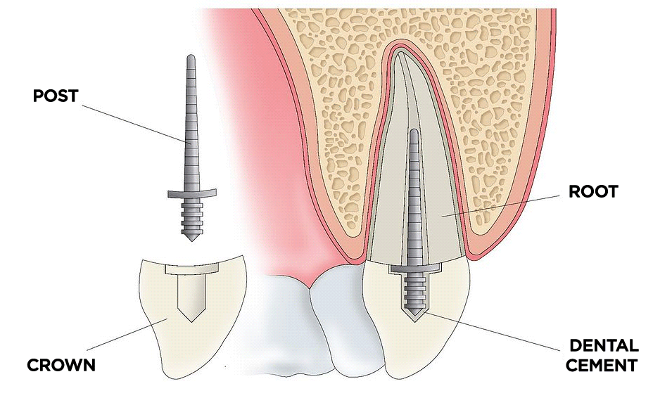 Post & Core: Your Tooth’s Best Defense Against Damage