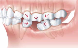 What Happens When You Lose a Tooth?