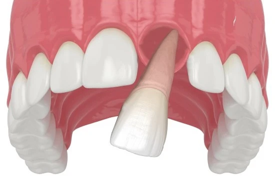 Knocked-Out Tooth or Broken Tooth? Here’s What to Do and How to save it ?