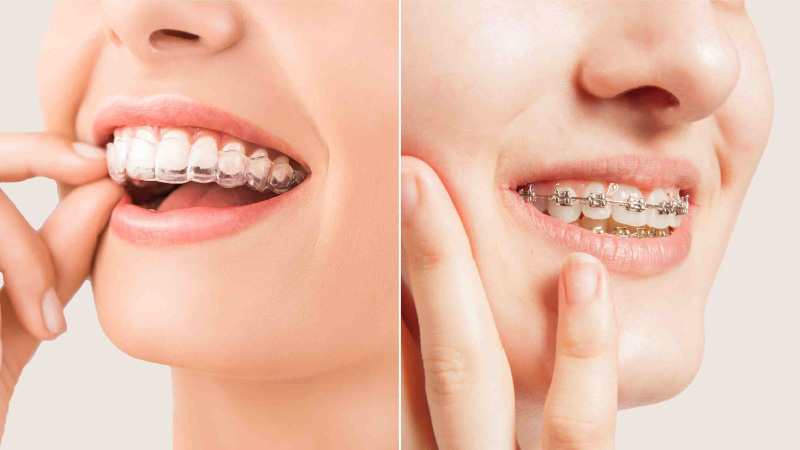 Braces vs Aligners: Which One’s the Game Changer for Your Smile?